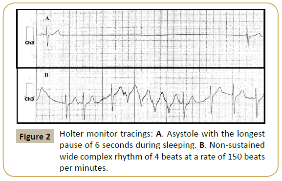 pediatric-cardiology-Holter-monitor-tracings