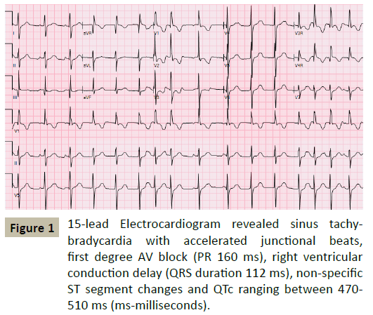 pediatric-cardiology-accelerated-junctional-beats