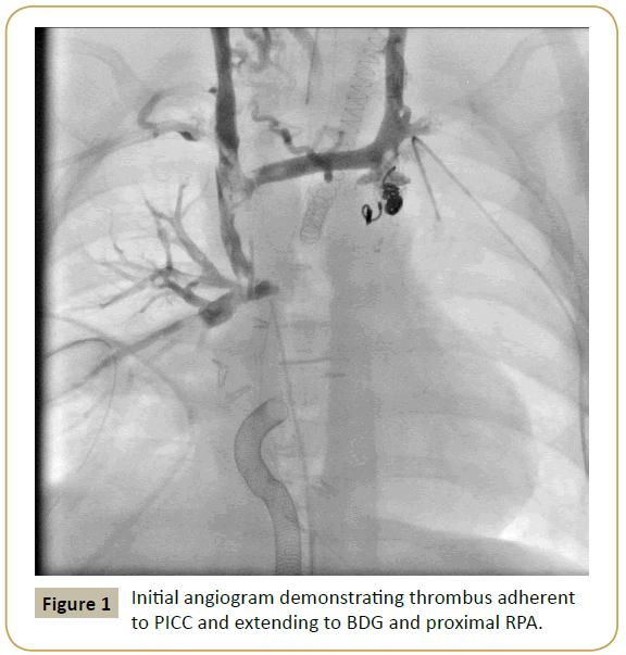 pediatric-cardiology-angiogram-demonstrating